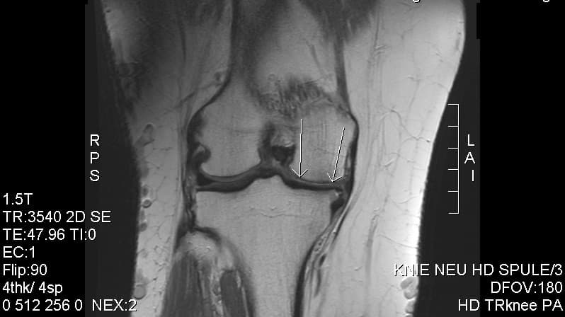 MRI showing cartilage loss in knee osteoarthritis